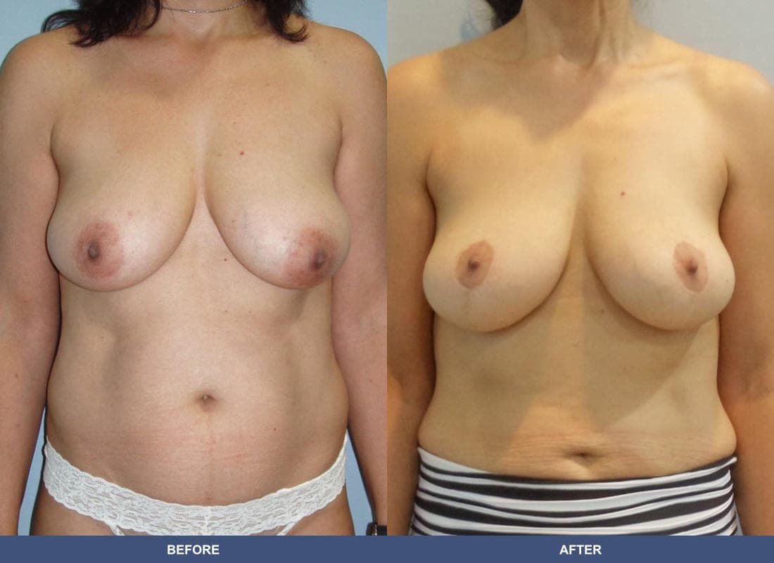 Breast Lift / Reduction before and after