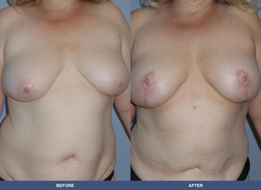Breast Lift / Reduction before and after