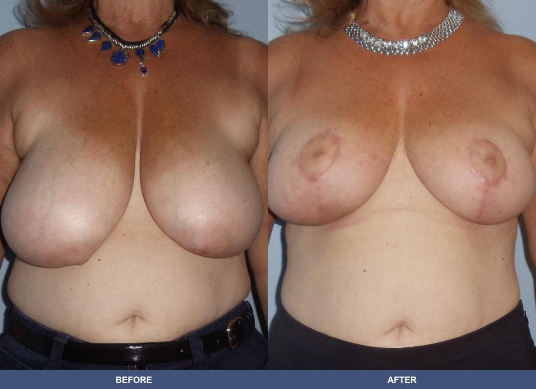 Breast Lift / Reduction before and after