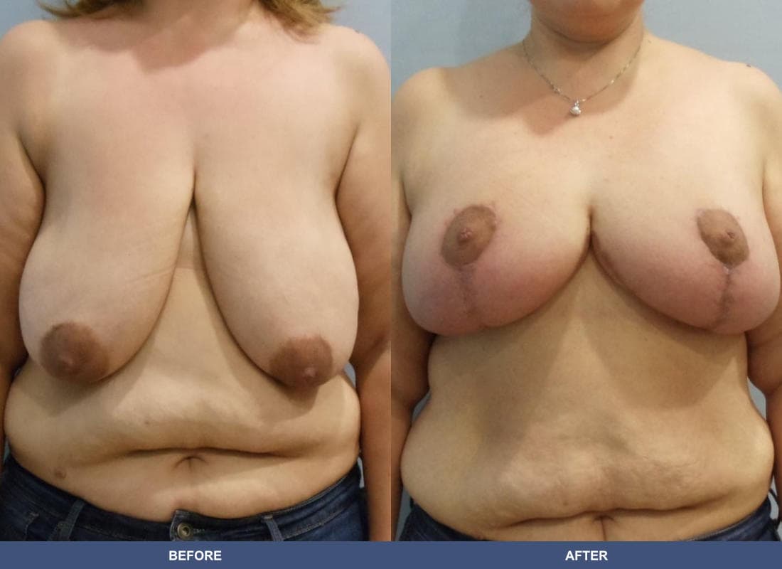 Breast Lift / Reduction before and after
