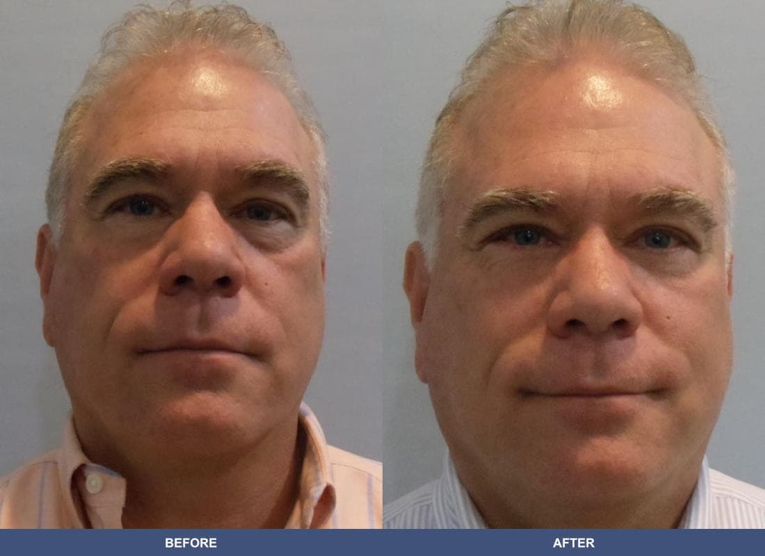 Eyelid Surgery before and after