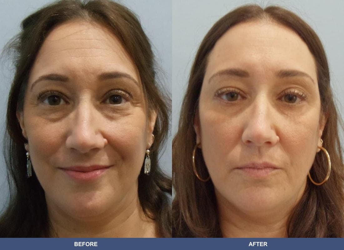 Eyelid Surgery before and after