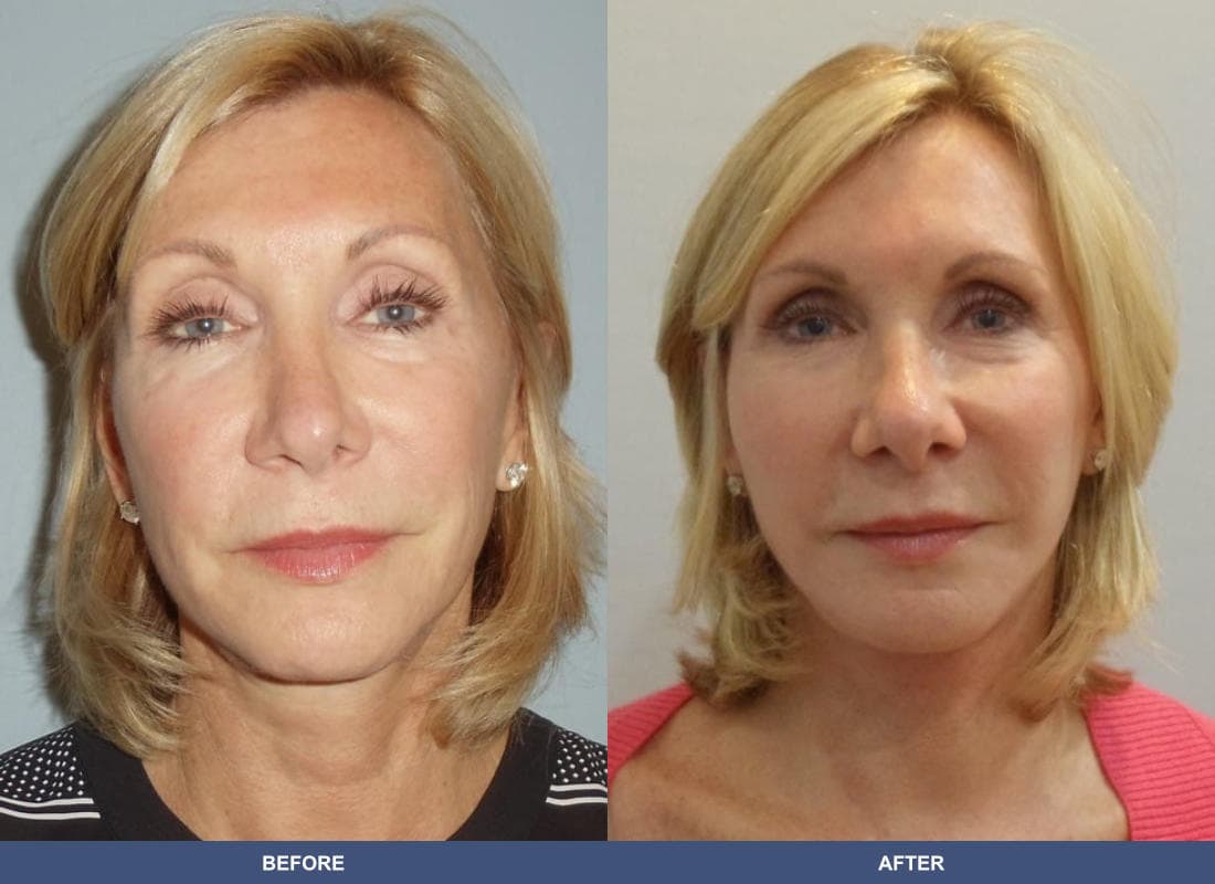 Face and Neck Lift before and after