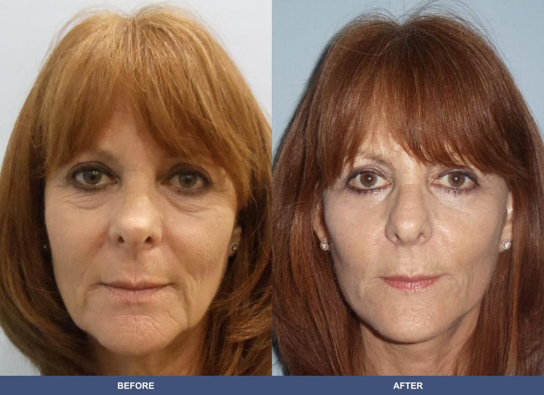 Face and Neck Lift before and after