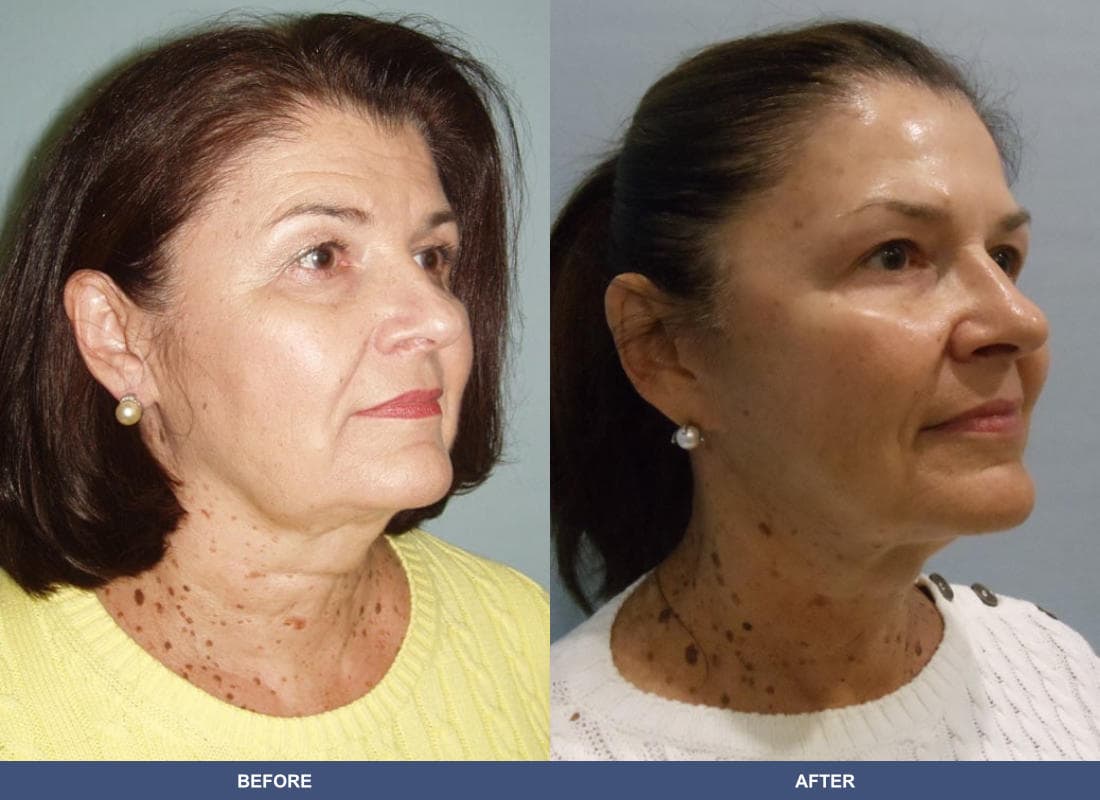 Face and Neck Lift before and after