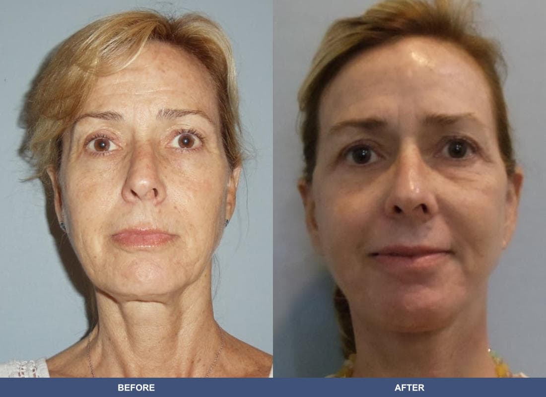 Face and Neck Lift before and after