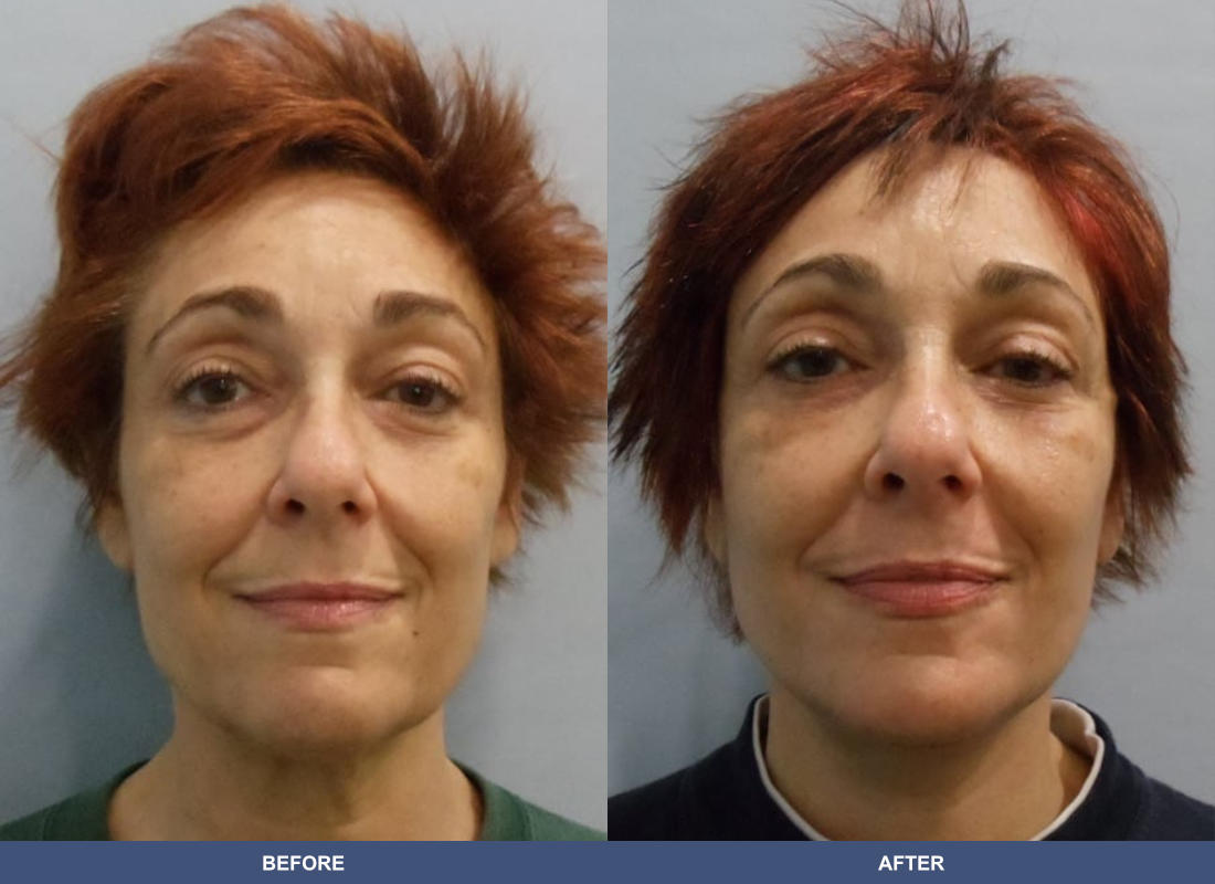 Face and Neck Lift before and after