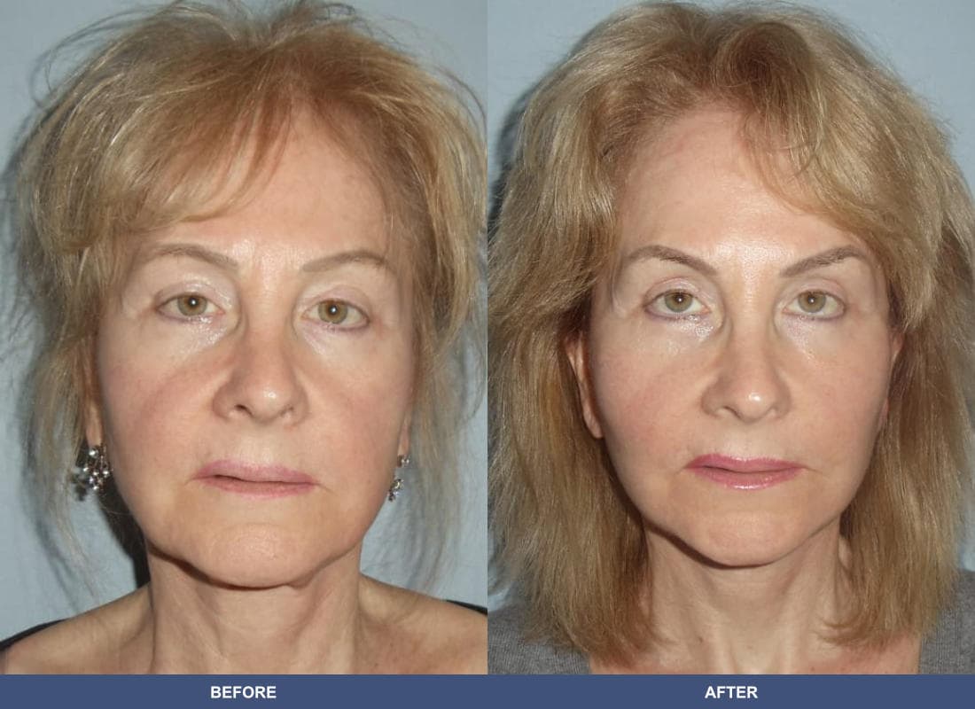 Face and Neck Lift before and after