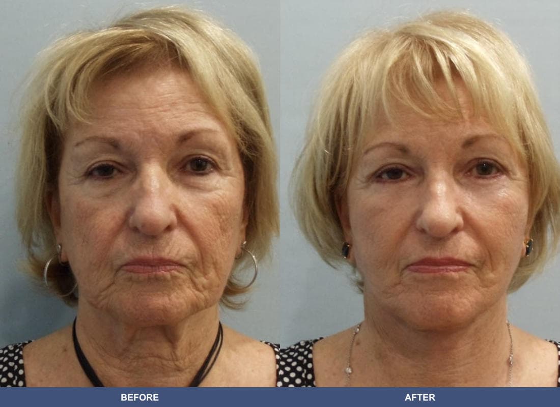 Face and Neck Lift before and after