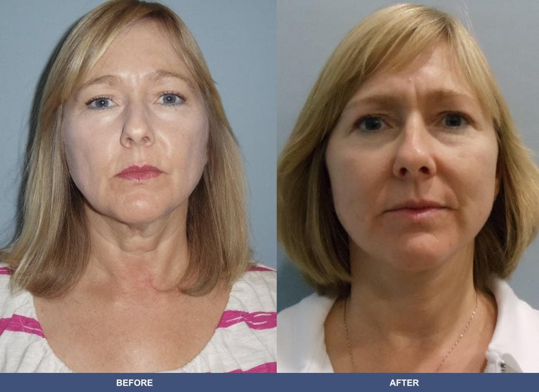 Face and Neck Lift before and after