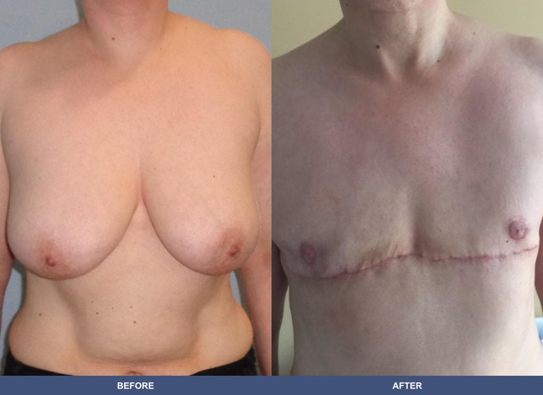 Gender Confirmation (FTM) before and after