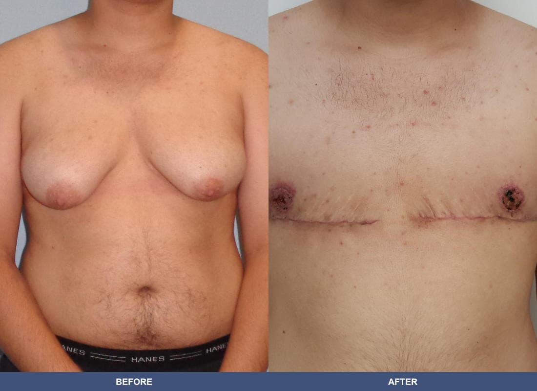 Gender Confirmation (FTM) before and after