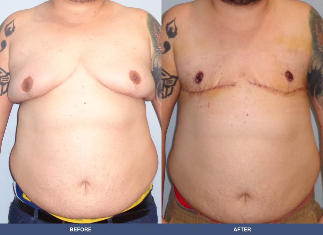 Gender Confirmation (FTM) before and after