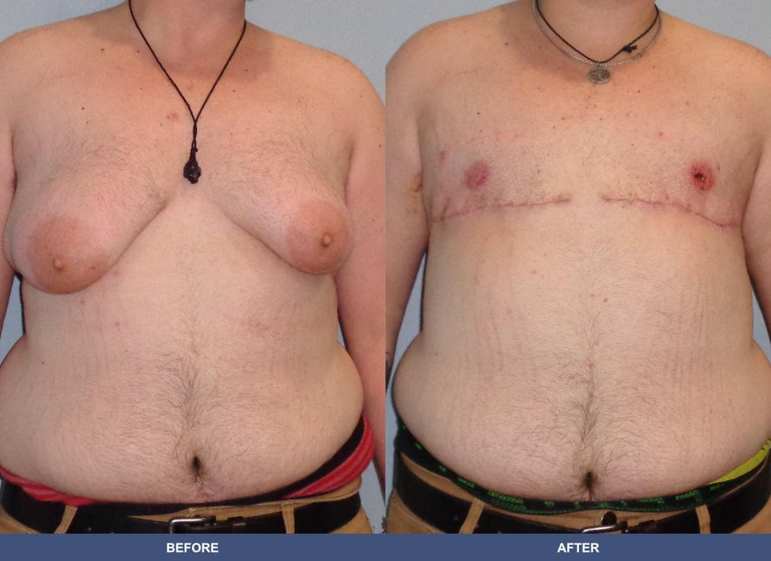 Gender Confirmation (FTM) before and after