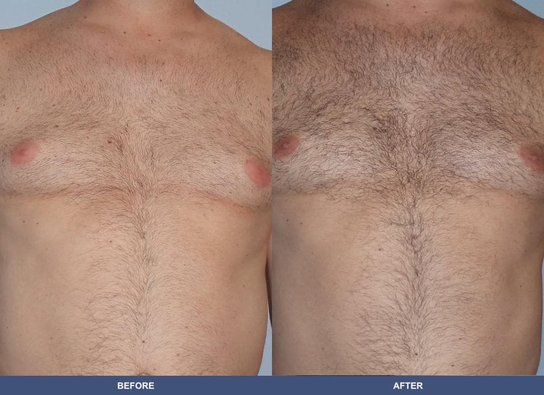 Gynecomastia before and after