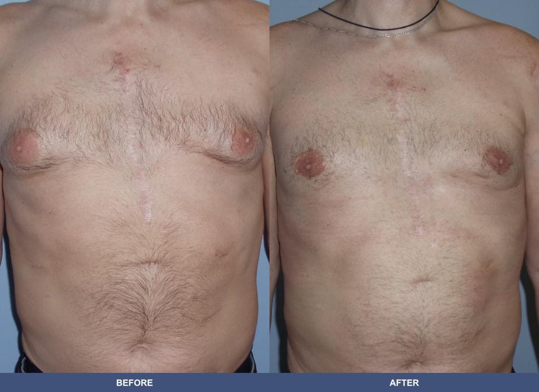 Gynecomastia before and after