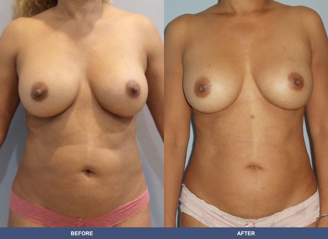 Liposuction before and after