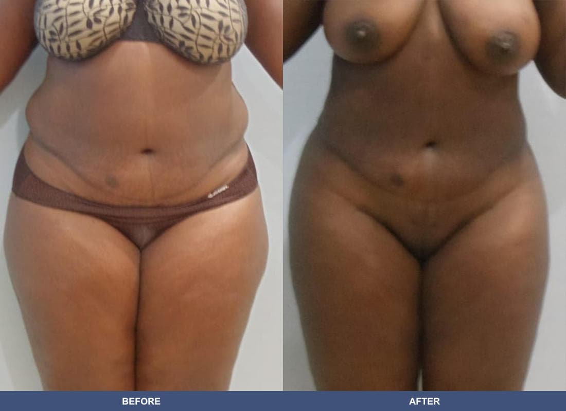 Liposuction before and after