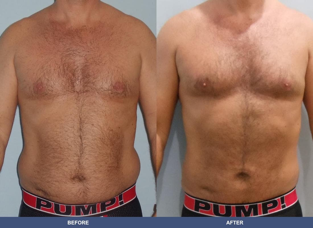 Liposuction before and after