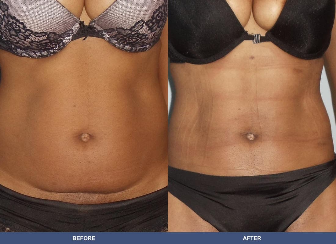 Liposuction before and after