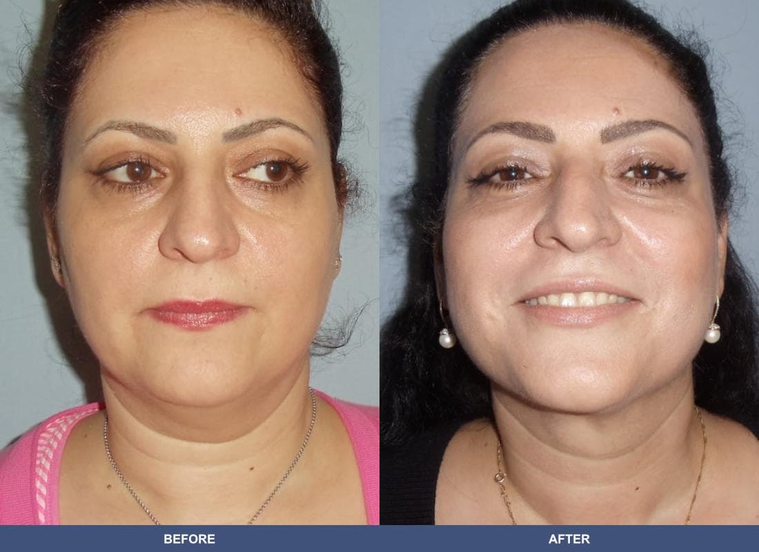 Liposuction before and after