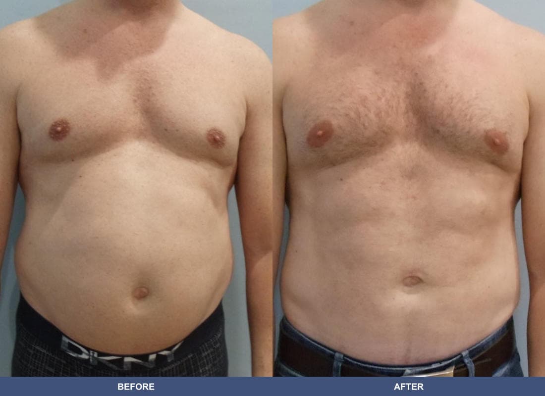 Liposuction before and after