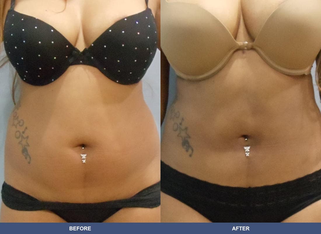 Liposuction before and after