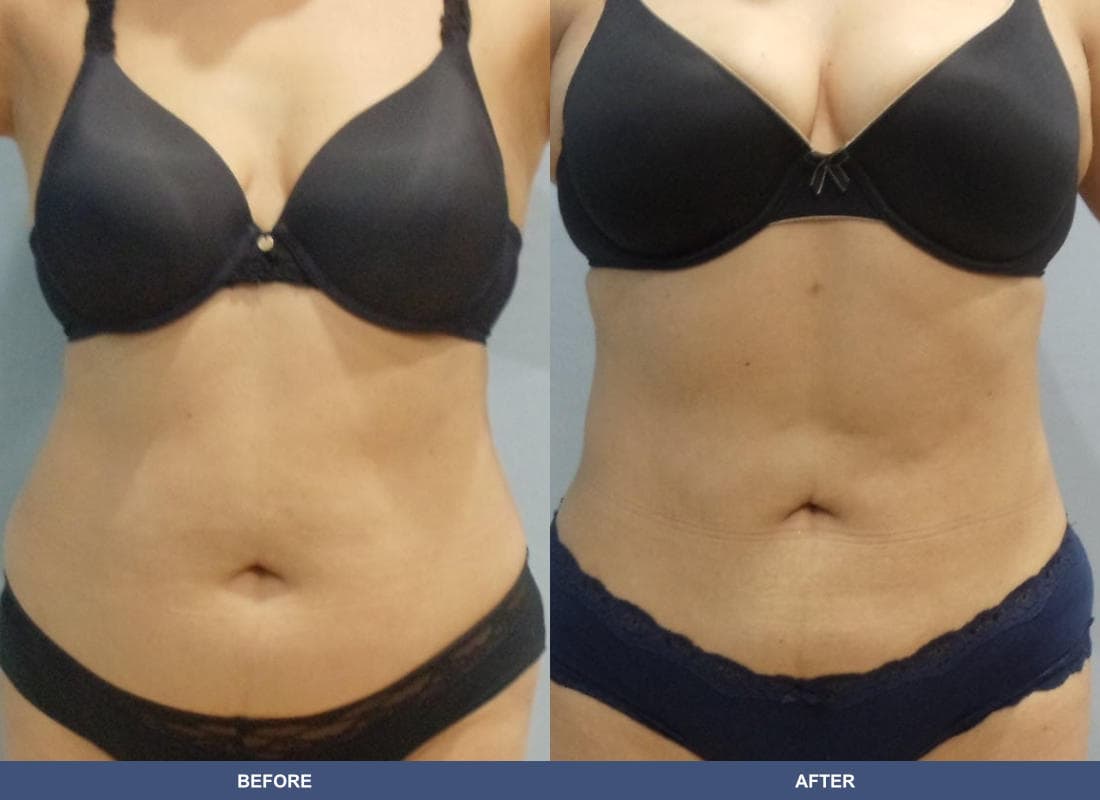 Liposuction before and after