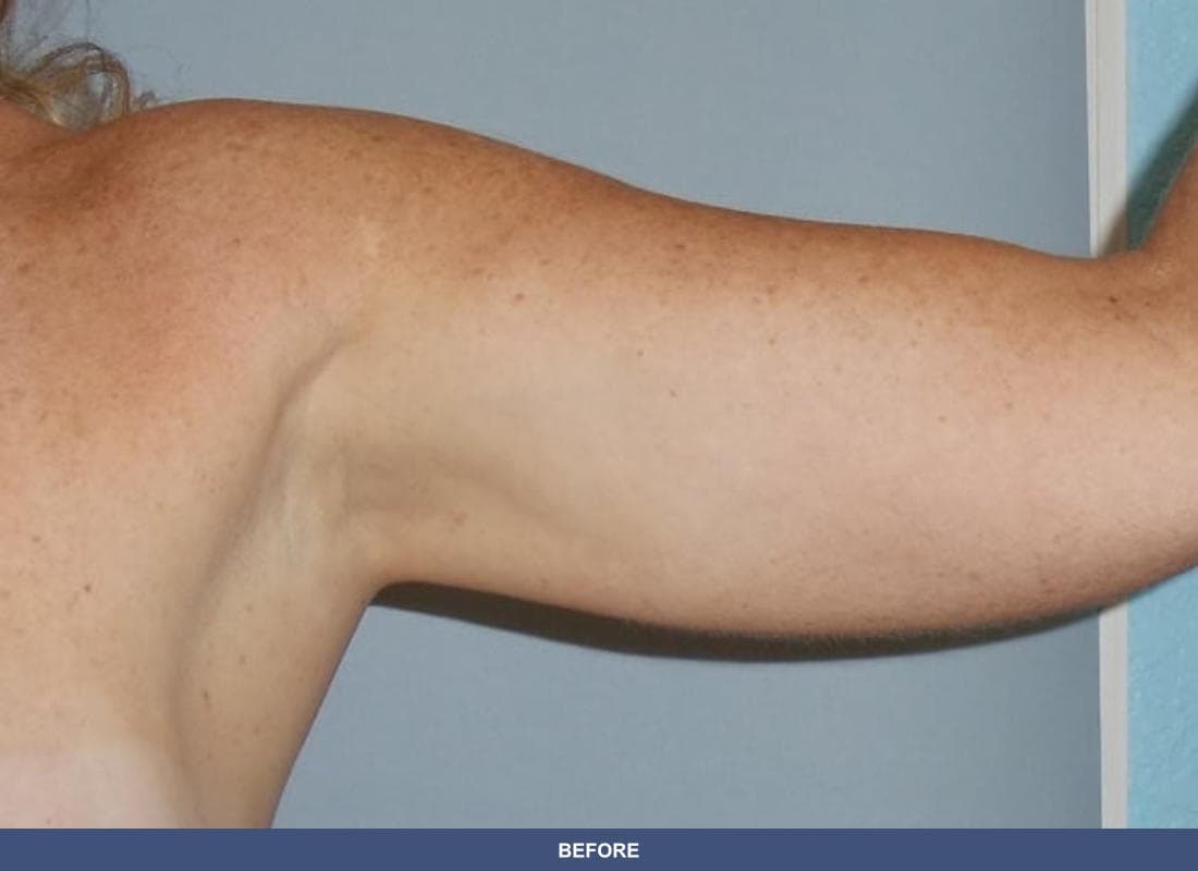 Liposuction before and after
