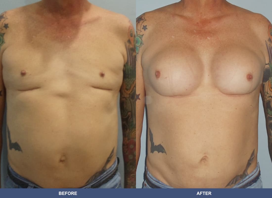 Gender Confirmation (MTF) before and after