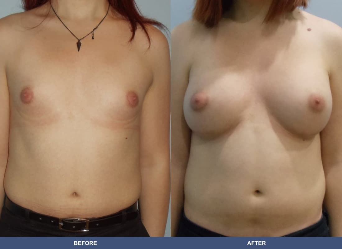 Gender Confirmation (MTF) before and after