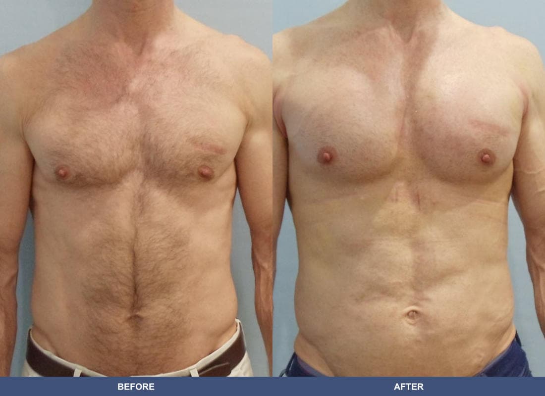 Pectoral Augmentation before and after