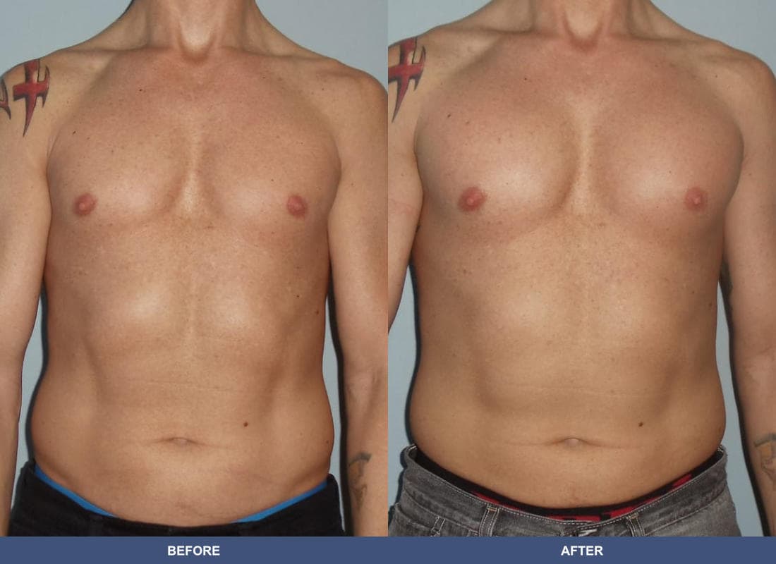 Pectoral Augmentation before and after