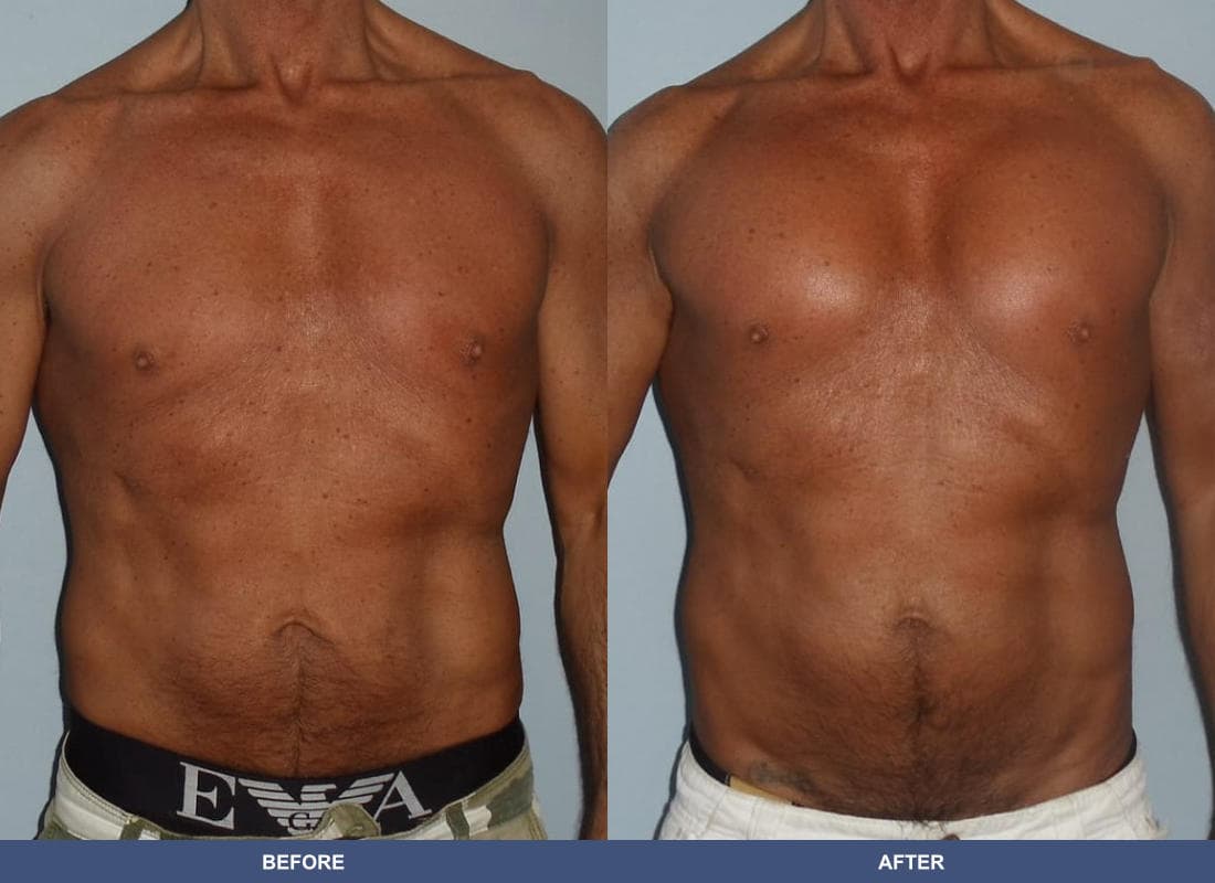 Pectoral Augmentation before and after