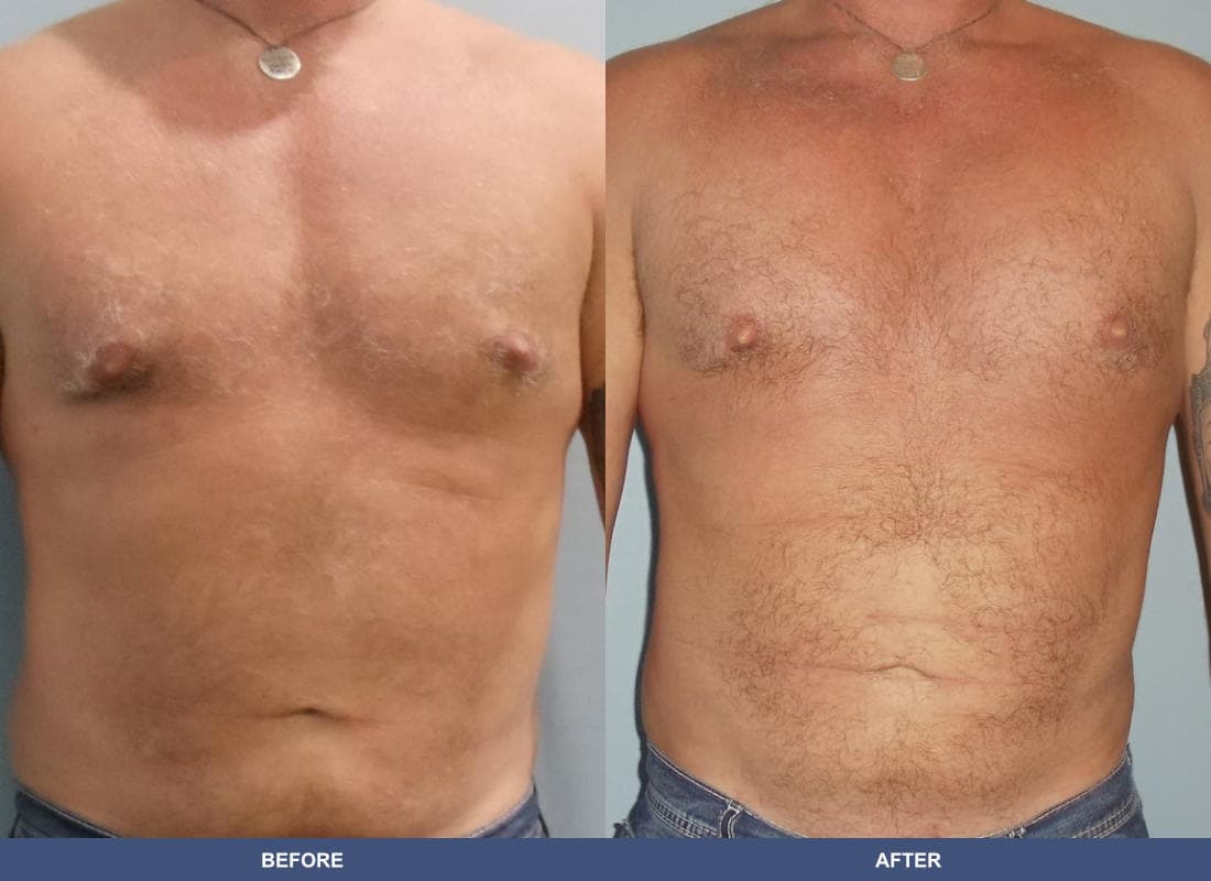 Pectoral Augmentation before and after