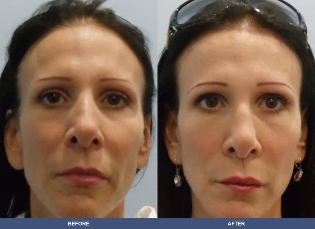 Rhinoplasty before and after