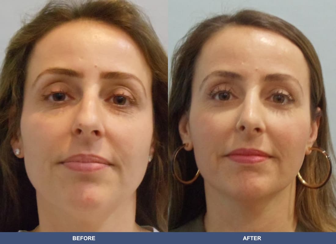Rhinoplasty before and after