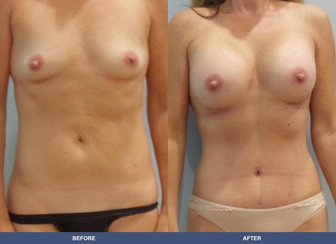 Tummy Tuck before and after