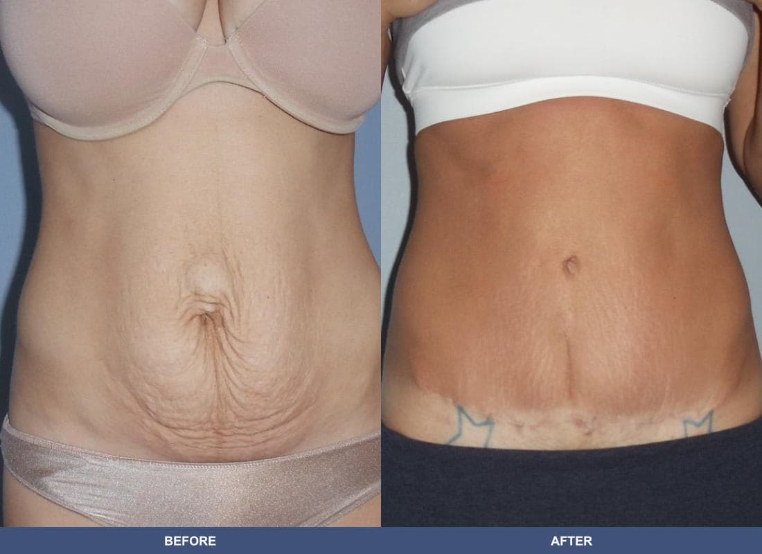 Tummy Tuck before and after