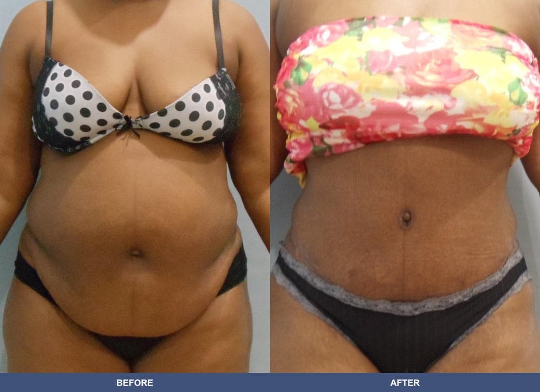 Tummy Tuck before and after