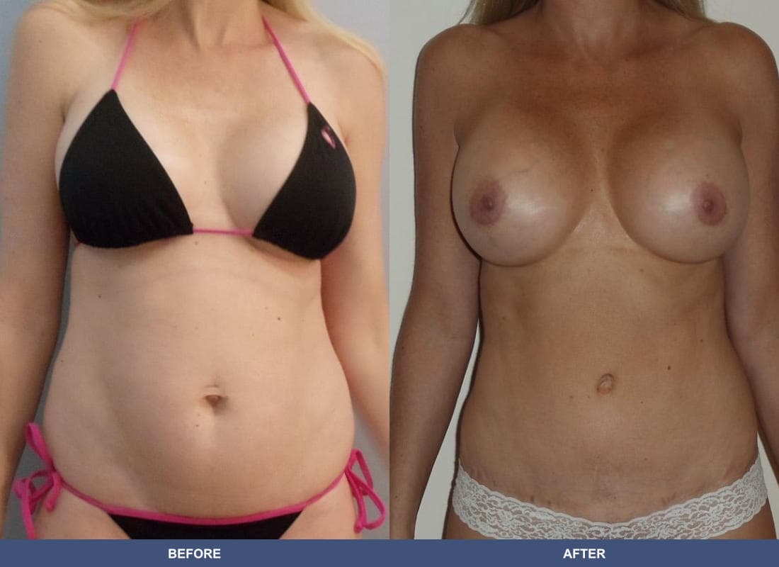 Tummy Tuck before and after