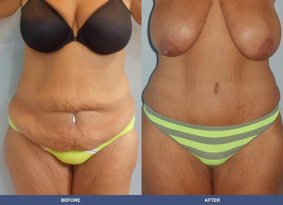 Tummy Tuck before and after